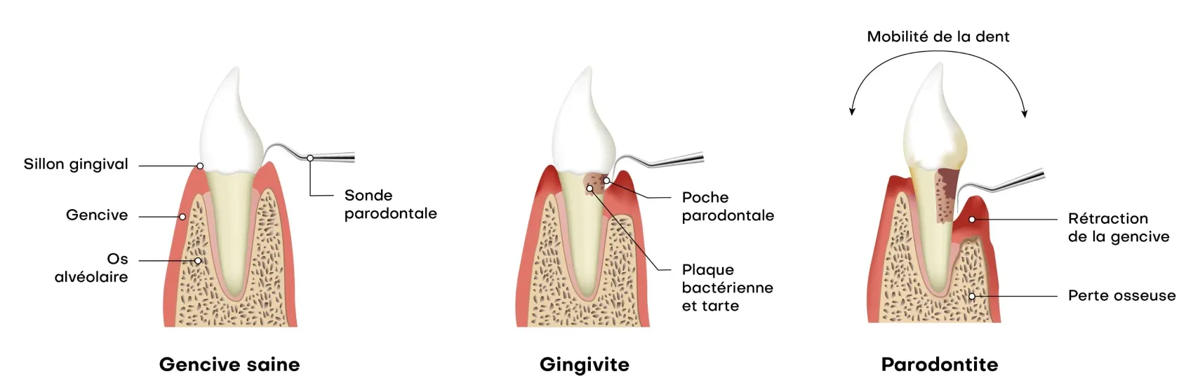 Dentistes Montigny-en-Gohelle 62640 gingivite