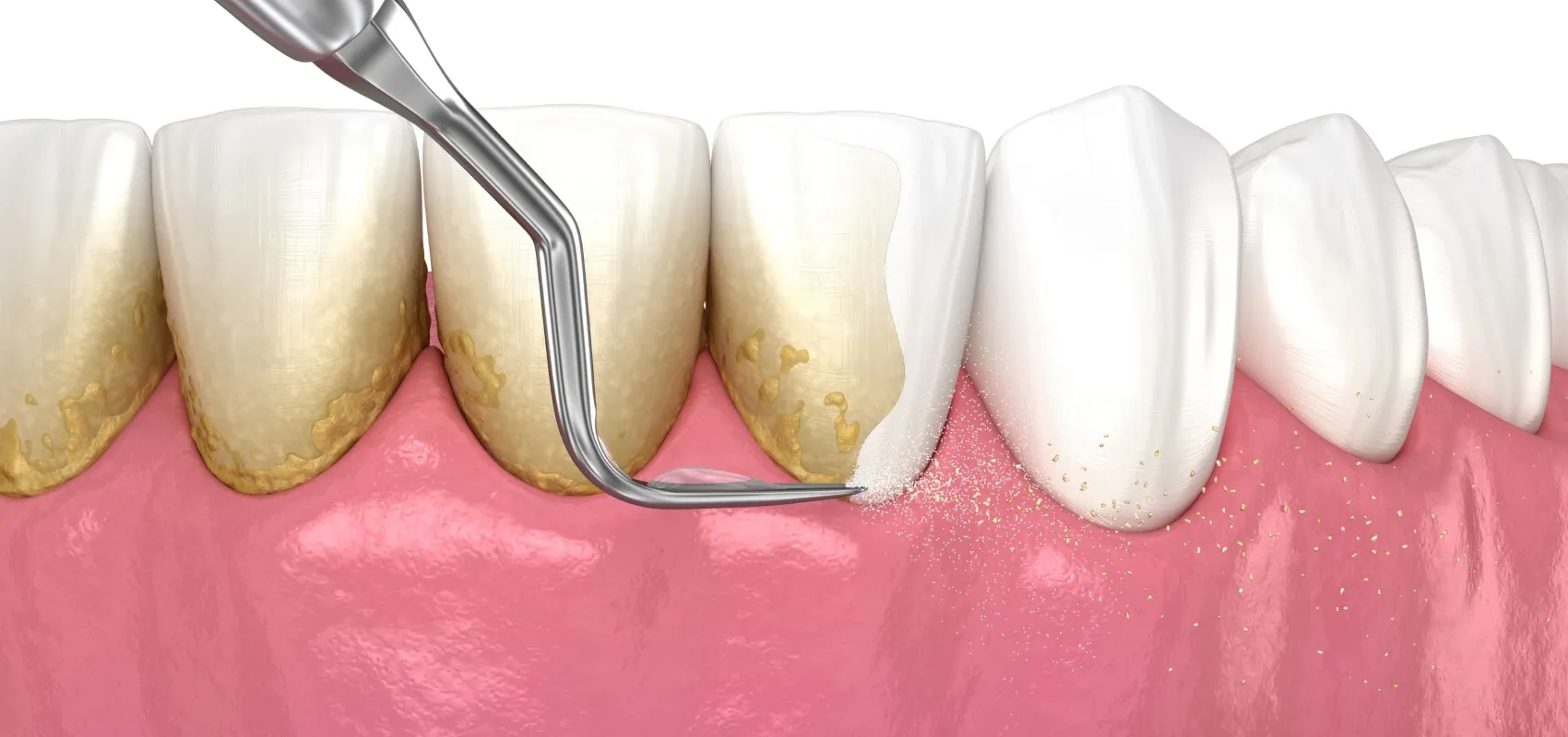 Dentistes Montigny-en-Gohelle 62640 Détartrage et polissage